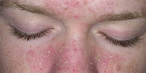 dermatite seborreica no rosto